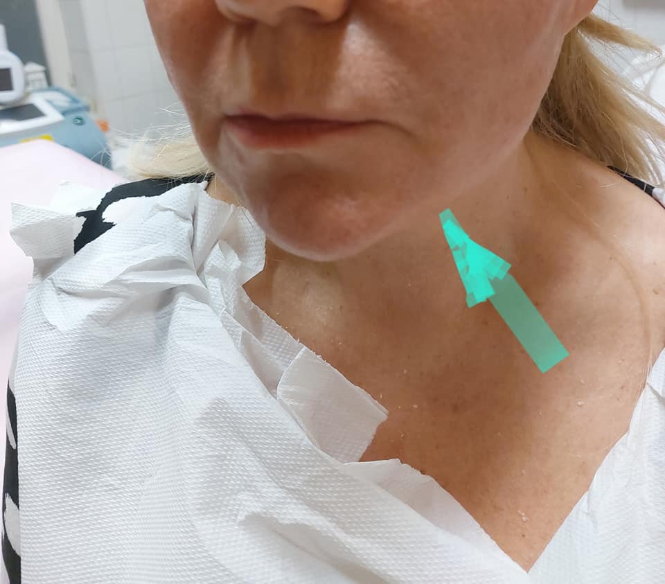 Állkontúr kezelése bioszálas felhúzással02