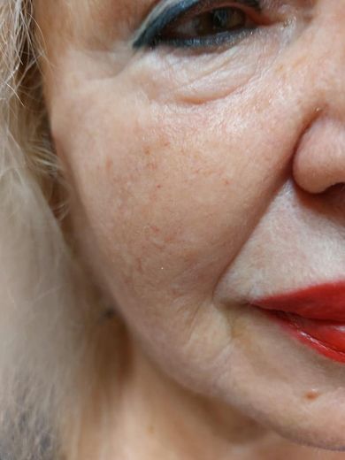 Bőr kímélőpattanásos bőr kezelés