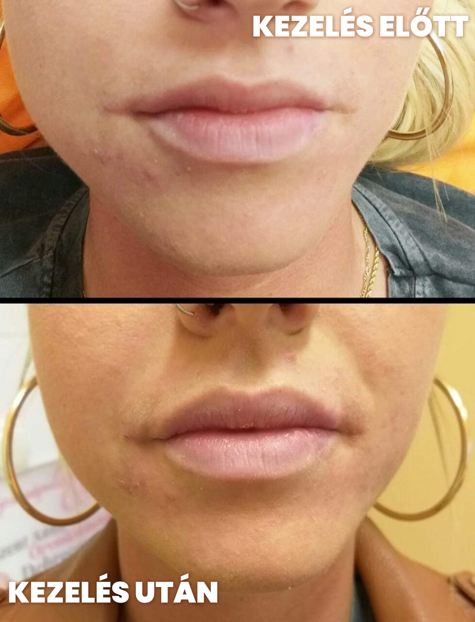 hyaluronsavas ajakfeltöltés gyakorlott kozmetikus segítségével