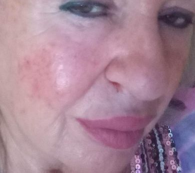 Lézeres pattanásos bőr kezelés gyors hatással