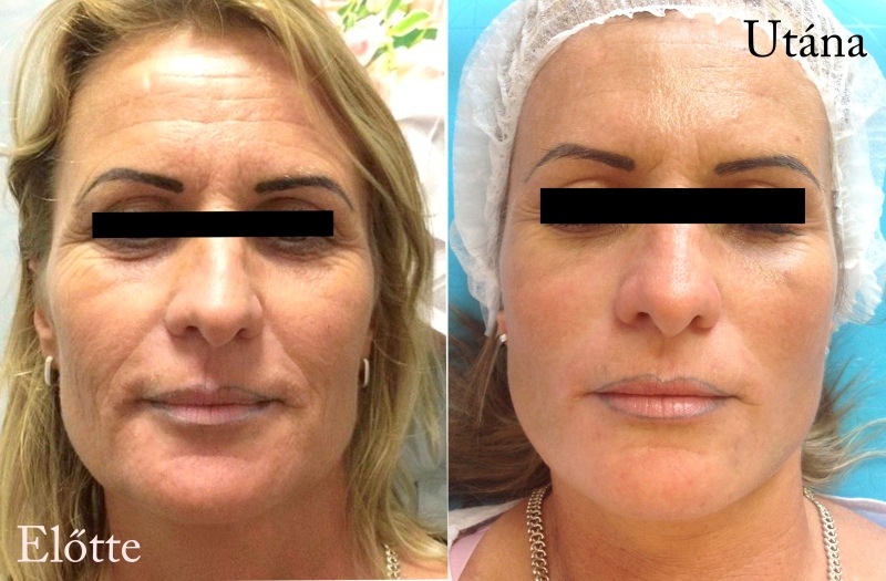 bioszálas arckontúr kezelés