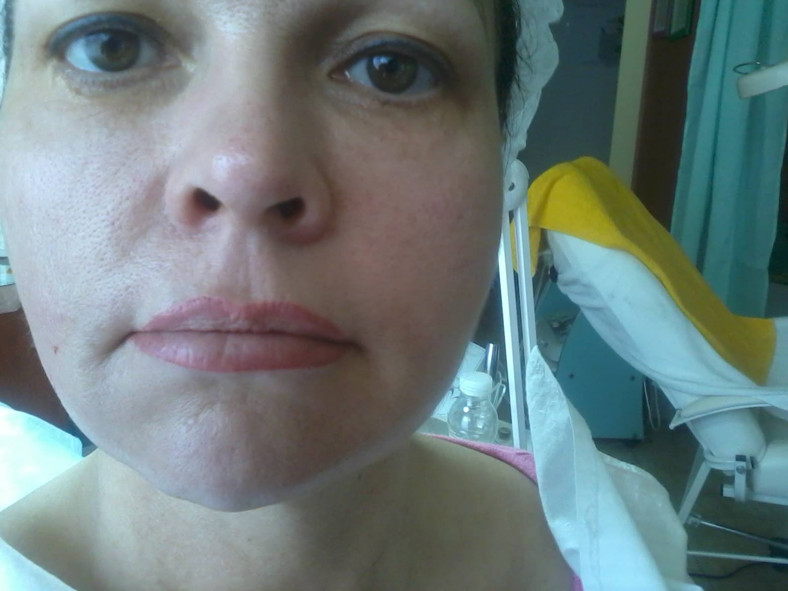 arckontúr kezelés bioszálakkal