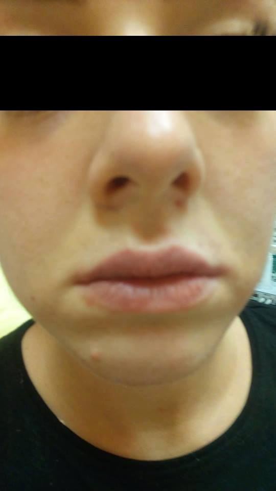 szájfeltöltés hyaluronsavval szakértők által