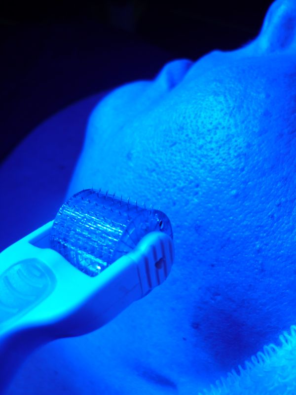 kollagé indukciós terápia