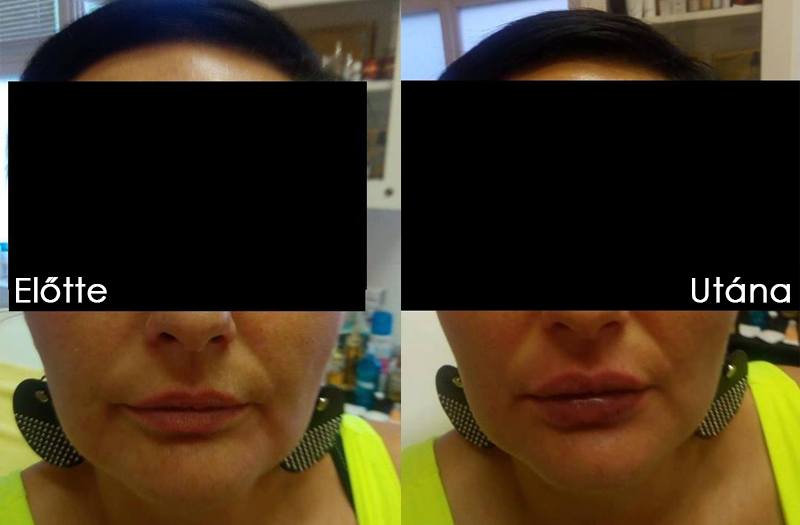hyaluronsavas ajakfeltöltés Debrecen belvárosában