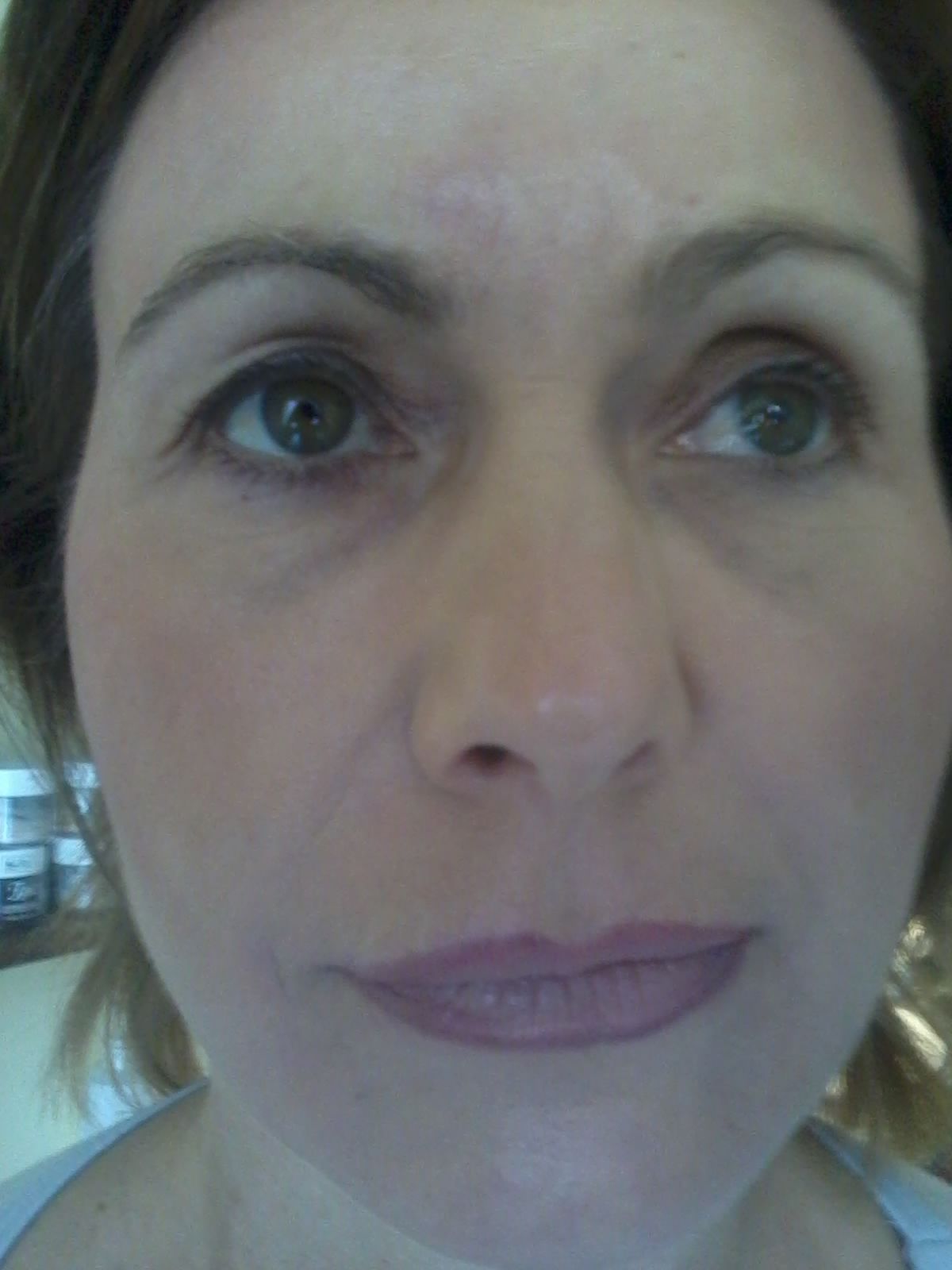 bioszálas arckontúr kezelés