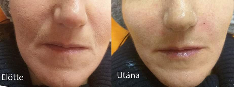 kétoldali arcfeltöltés debrecen