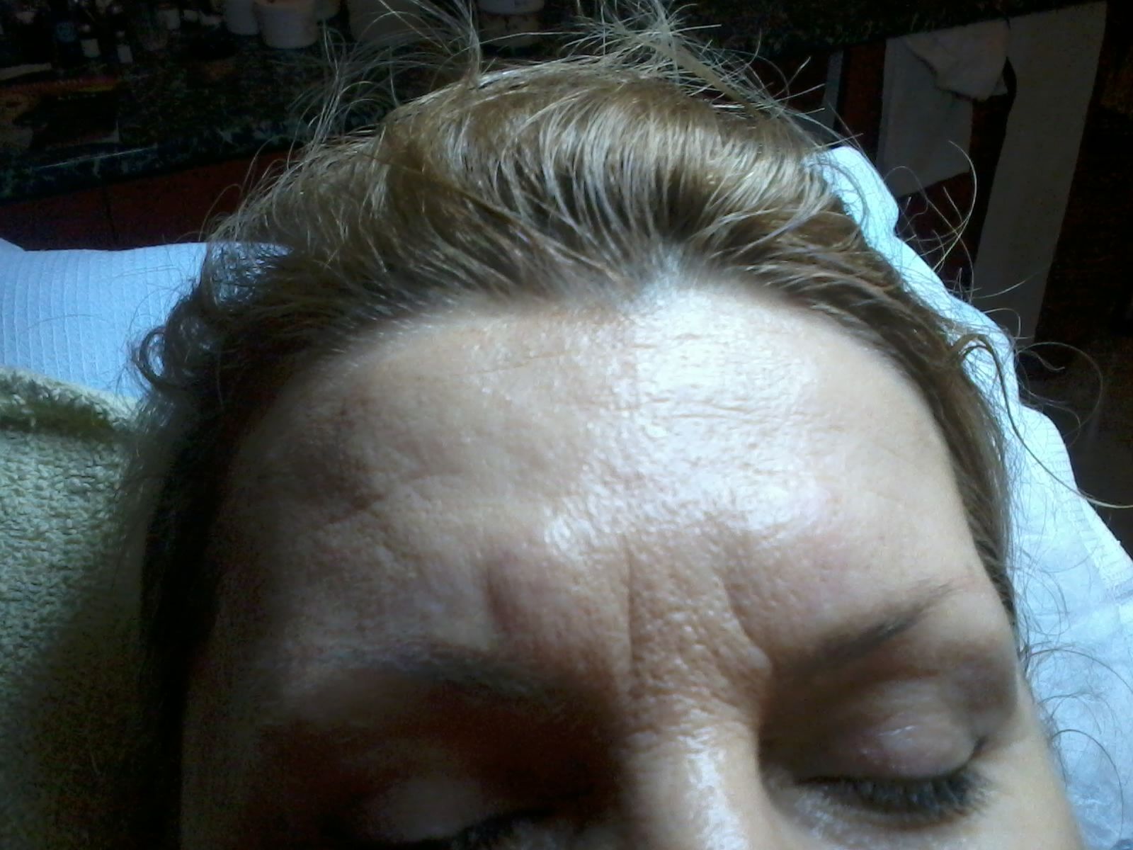 arckontúr kezelés bioszálakkal