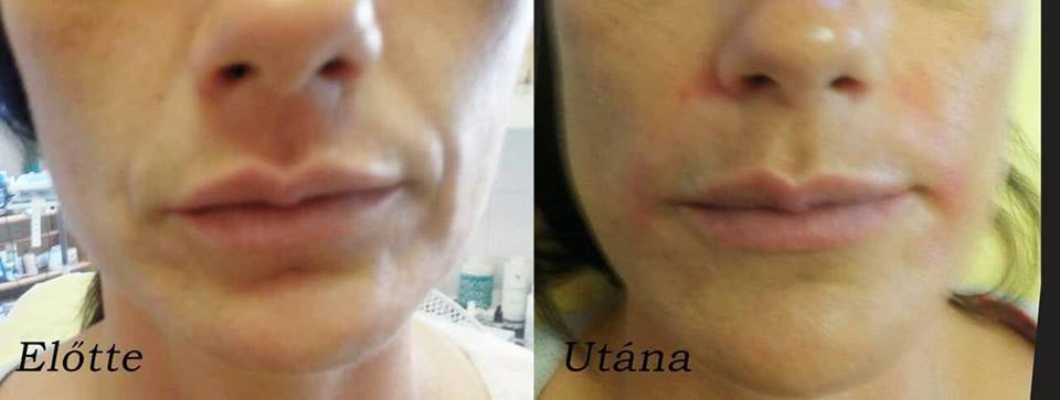 hyaluronsavas szájfeltöltés debrecen a száj melletti ráncok eltüntetésére