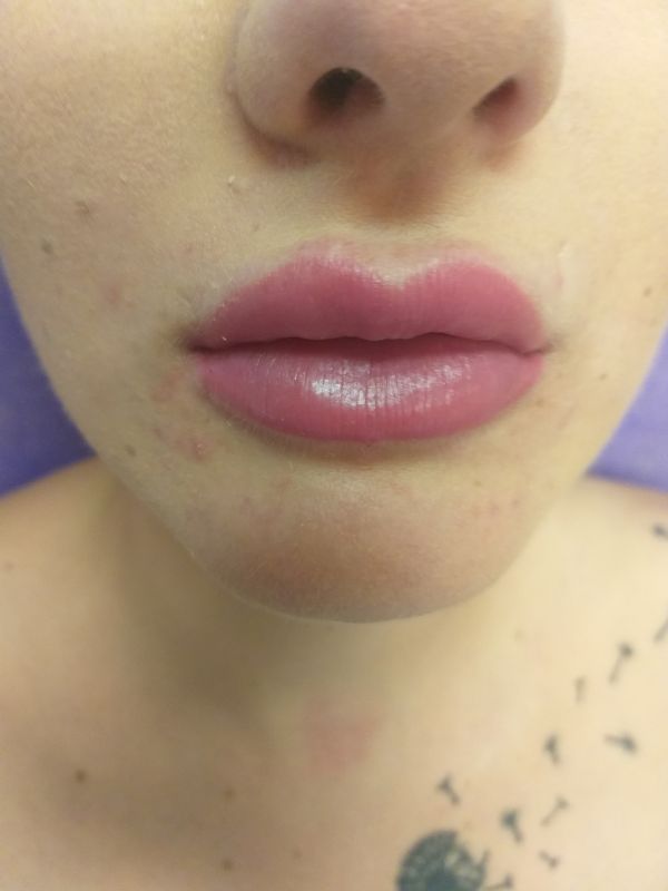 szolgáltatásunk a formás ajkakhoz: hyaluronsavas szájfeltöltés debrecen