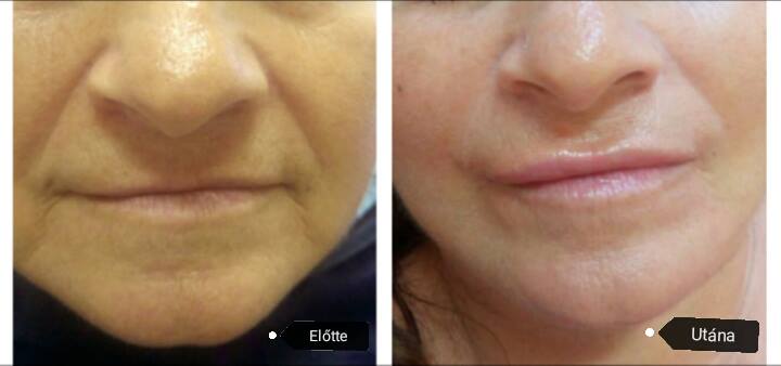 hyaluronsavas szájfeltöltés Debrecen tapasztalt kozmetikus által