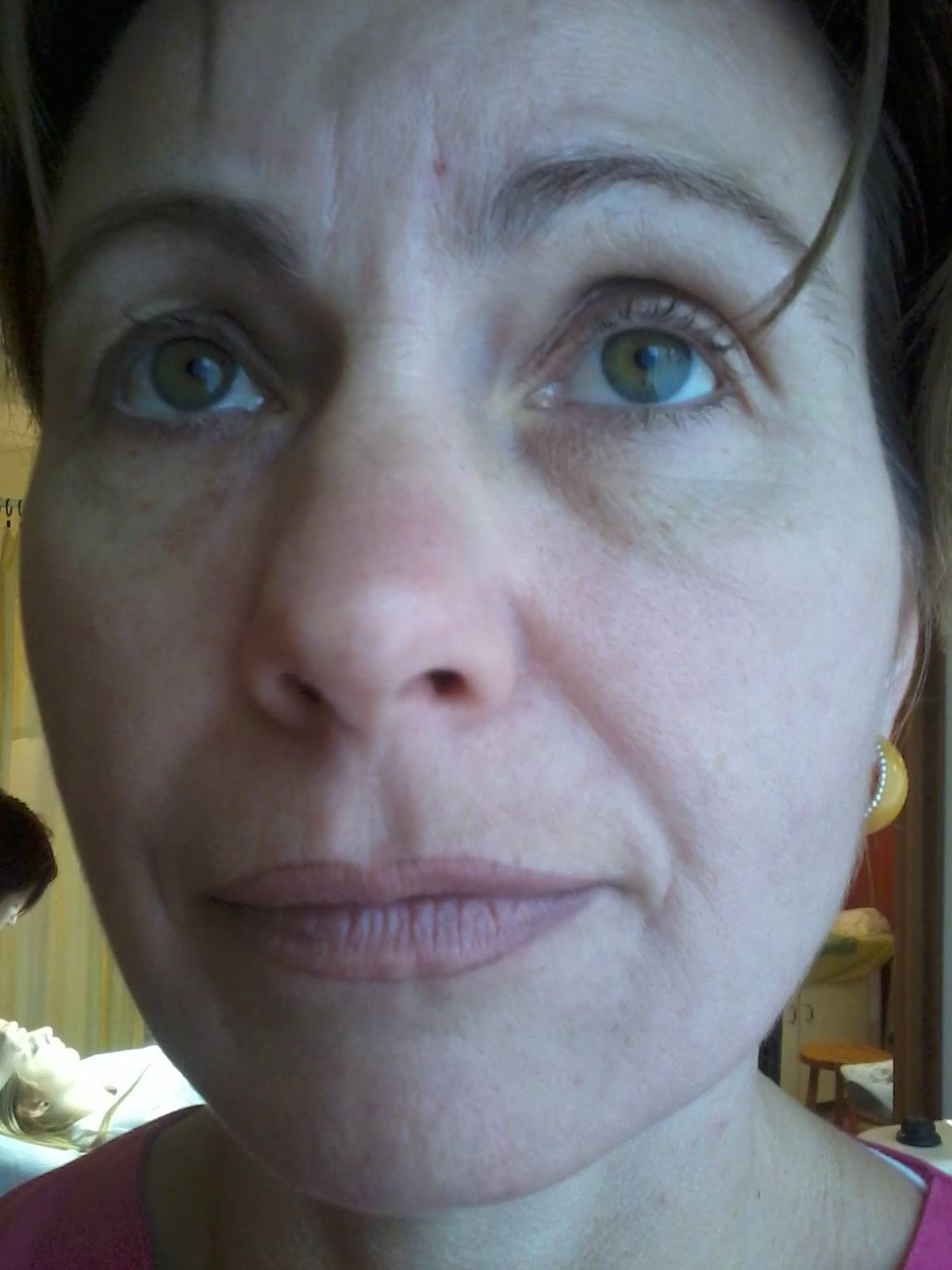 bioszálas arckontúr kezelés