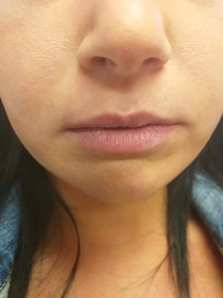 hyaluronsavas szájfeltöltés debrecen előtt