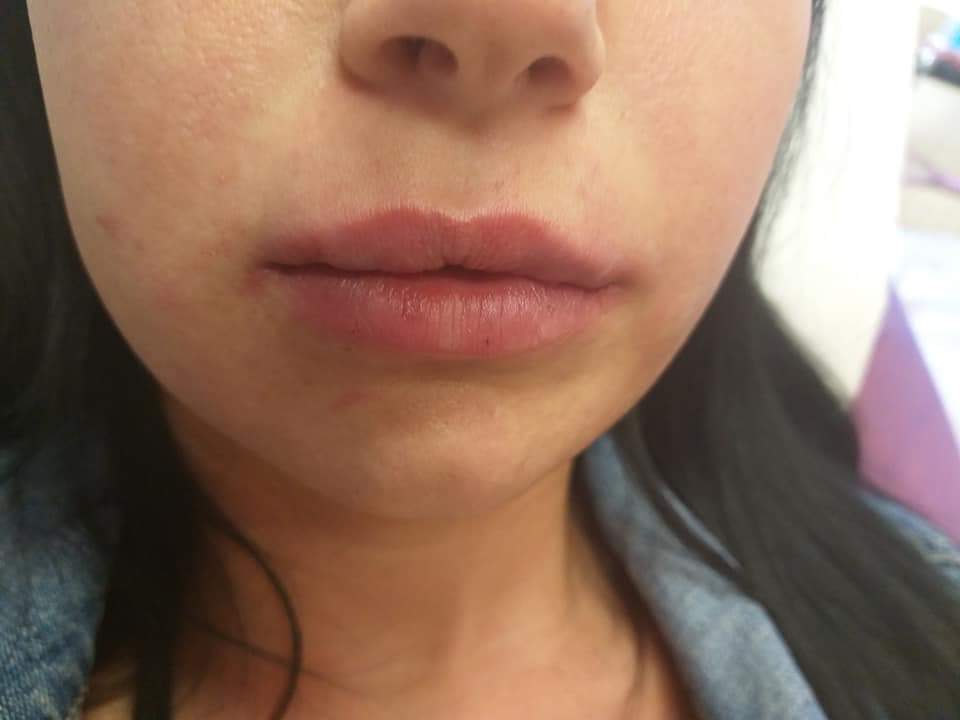 ajakfeltöltés után